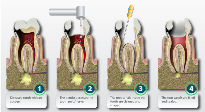 Root-canal-procedure