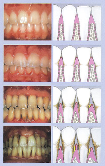 periodontal